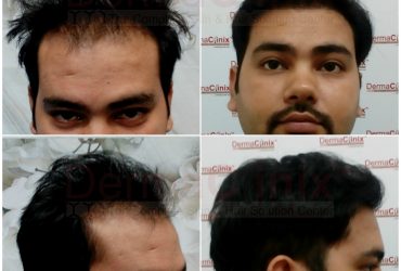 Best Hair Transplantation in Chennai