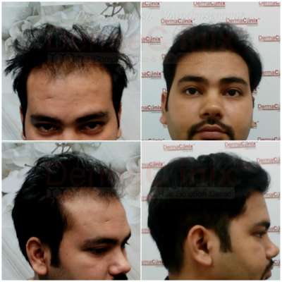 Best Hair Transplantation in Chennai