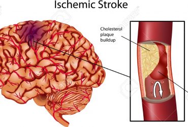 Thrombolytic Therapy for Stroke