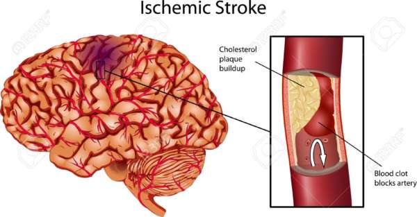 Thrombolytic Therapy for Stroke