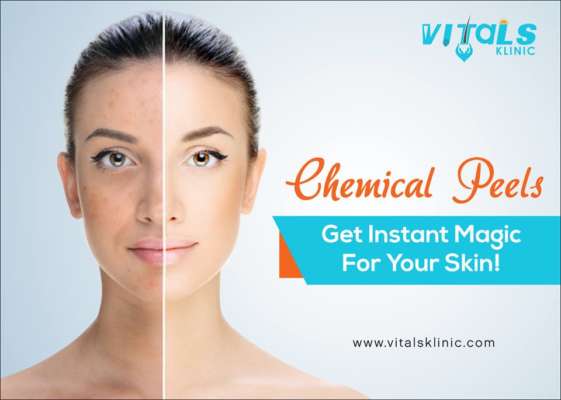 Treat your acne scars with chemical peels