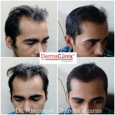 Hair Transplant Surgery in Chennai