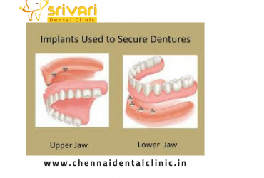 Affordable Implant Supported Dentures in Chennai