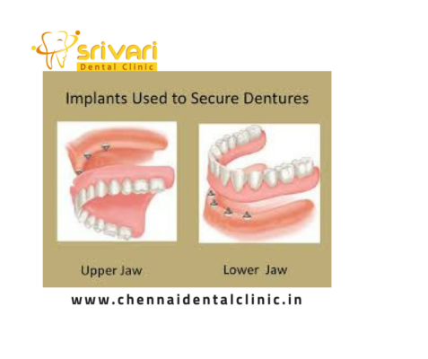 Affordable Implant Supported Dentures in Chennai