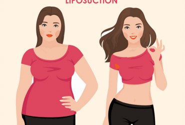 Shape Your Body With Liposuction