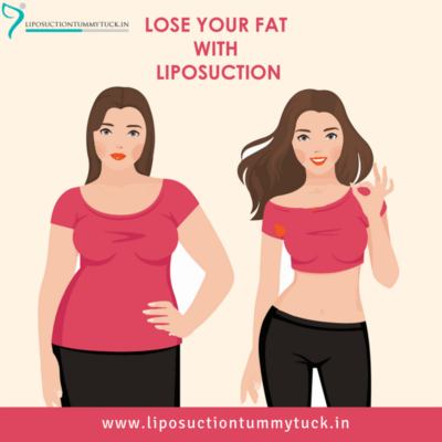 Shape Your Body With Liposuction