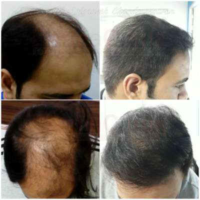 Hair Transplantation At 0% Risk Free at Best Hair Transplant Clinic in Chennai