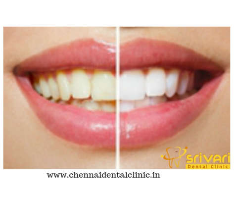 Best Tooth Whitening Procedure in Chennai