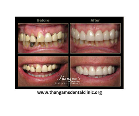 Restore your Smile with Cosmetic Dentistry