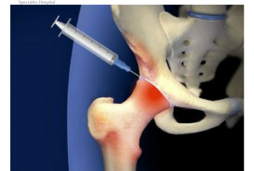 PRP Treatment For Hip Pain