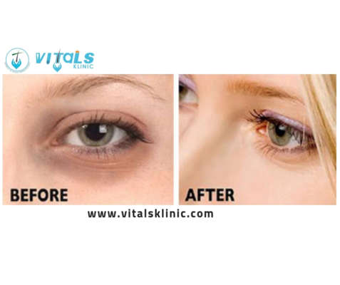 Get Rid Of Under Eye Dark Circles