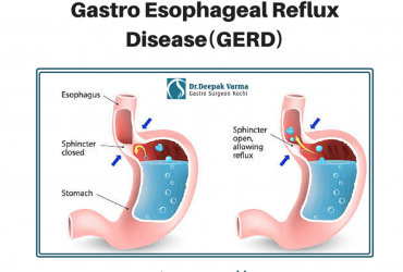 Get Effective Treatment For Acid Reflux