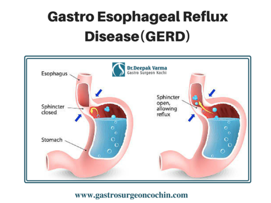 Get Effective Treatment For Acid Reflux