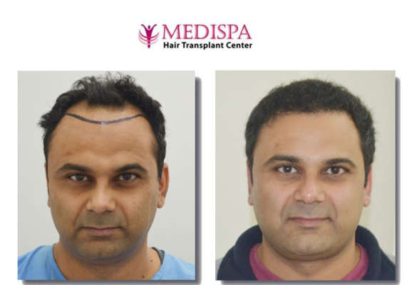 Best Hair Transplant Clinic in Jaipur