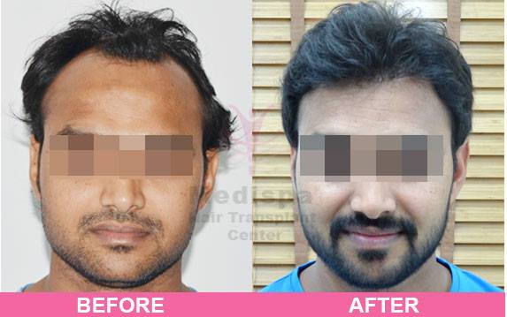 Best Hair Transplant Clinics in Delhi