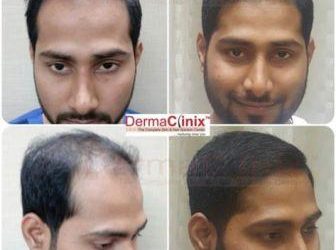 How to Receive Successful Results from Hair Transplantation Surgery?