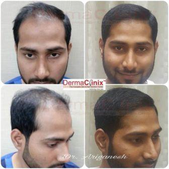 How to Receive Successful Results from Hair Transplantation Surgery?