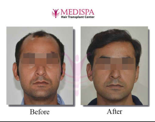 Best Hair Transplant Clinics in Delhi