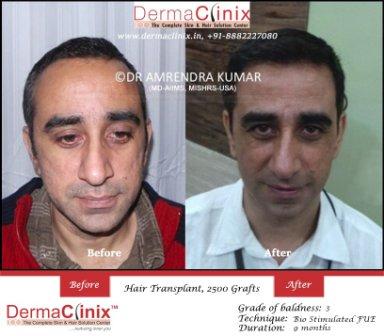 Hair Transplant Center in Delhi