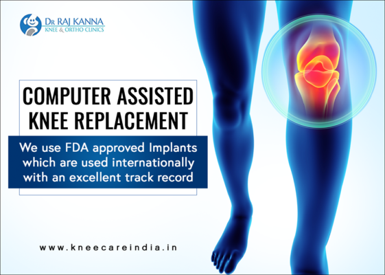 Cost Effective Computer Assisted Knee Replacement