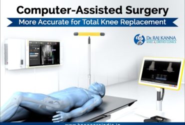 Cost Effective Computer Assisted Knee Replacement