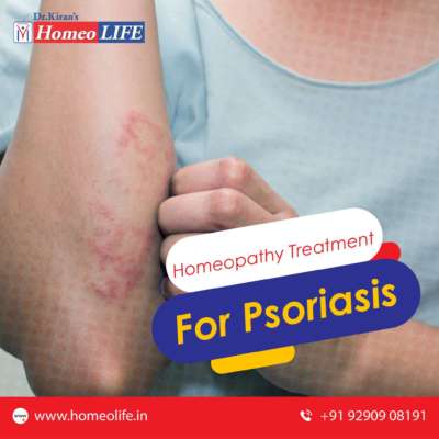 Treatment For Psoriasis | Symptoms And Causes Of Psoriasis- Homeolife