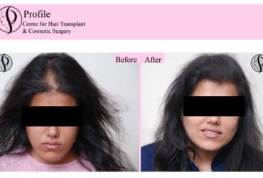 Finest Hair Transplant in India