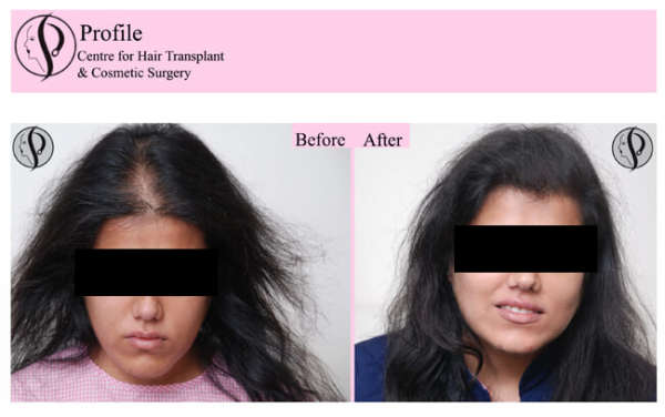 Finest Hair Transplant in India