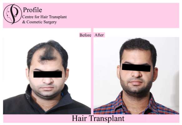 Best Centre For Hair Transplant Surgery in Punjab