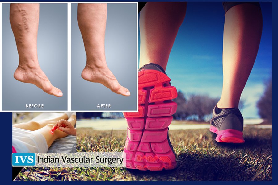 Laser Varicose veins Treatment | Varicose veins Specialists India – Indian Vascular Surgery