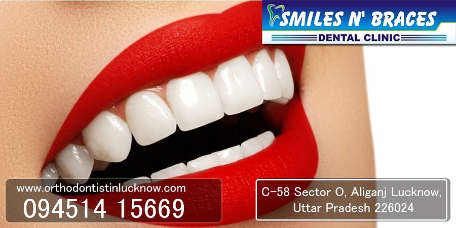 Braces in Lucknow | Dentist in Aliganj | Orthodontist in Lucknow