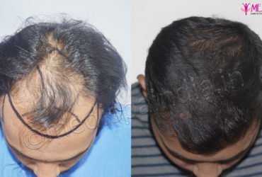 Best Hair Transplant Clinic in Jaipur