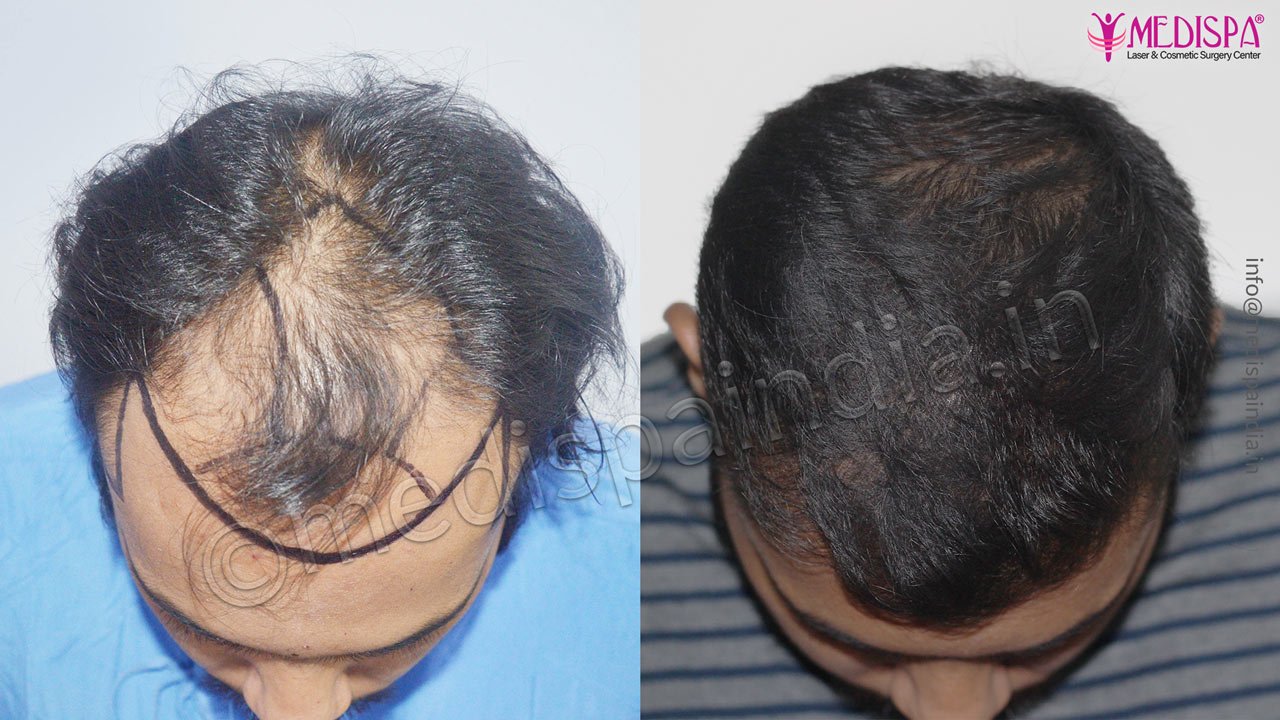 Best Hair Transplant Clinic in Jaipur