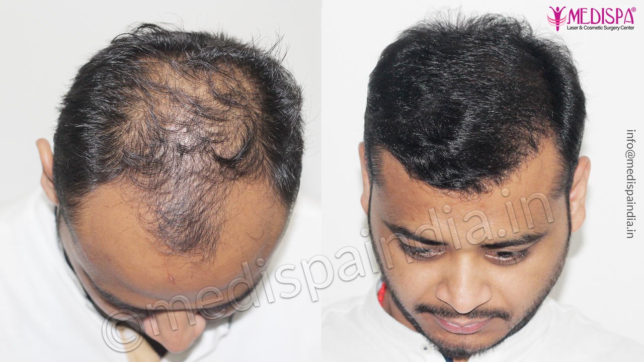 Best Hair Transplant Clinic in Jaipur