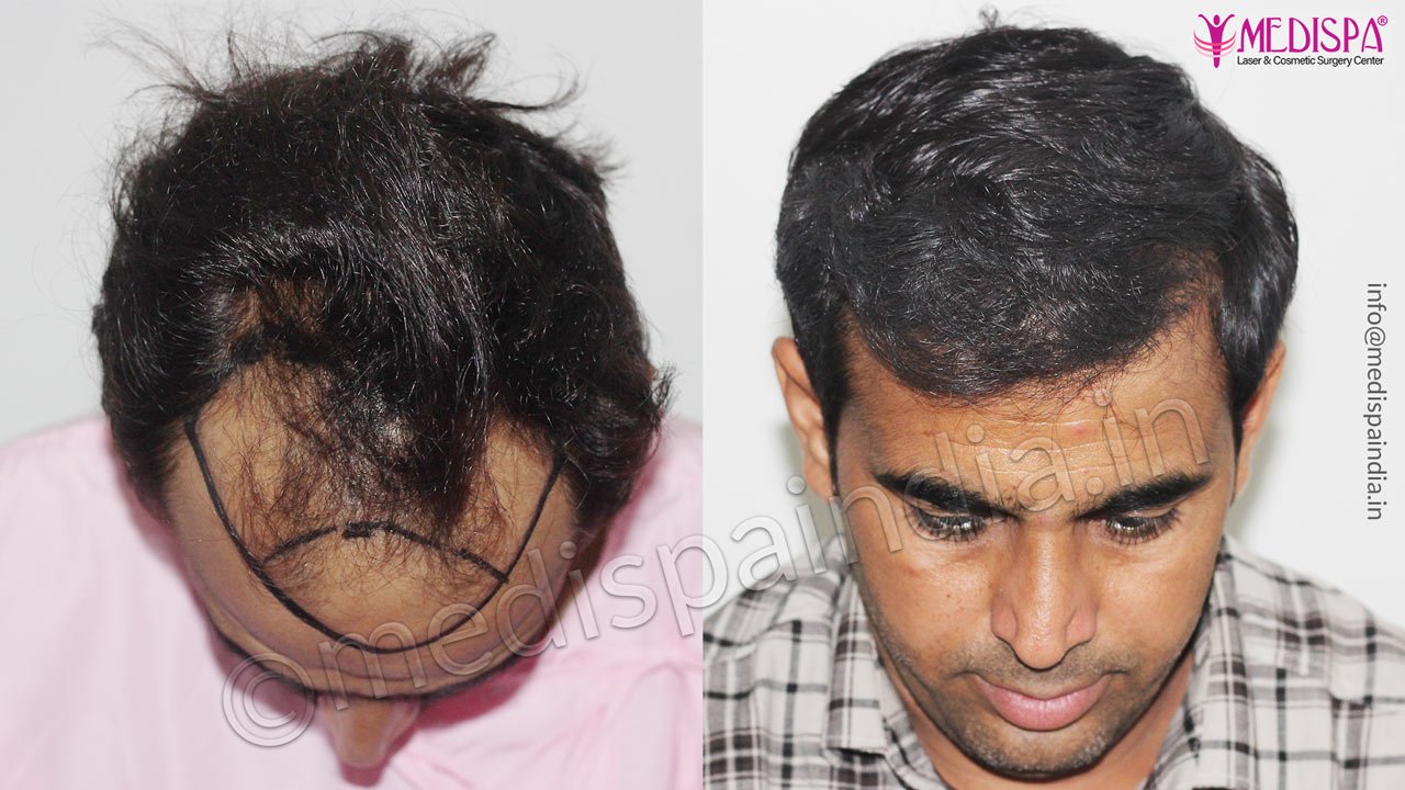 Best Hair Transplant Clinic in Jaipur