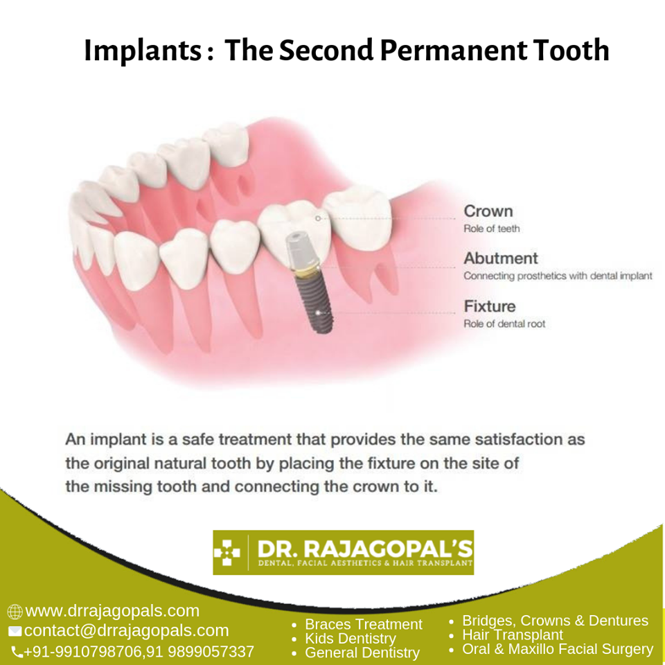 Best dental implant treatment in gurgaon