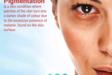 Skin Whitening Treatment in Bangalore