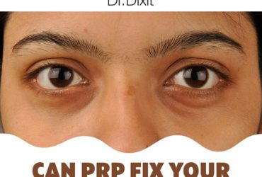 Pigmentation Treatment in Bangalore