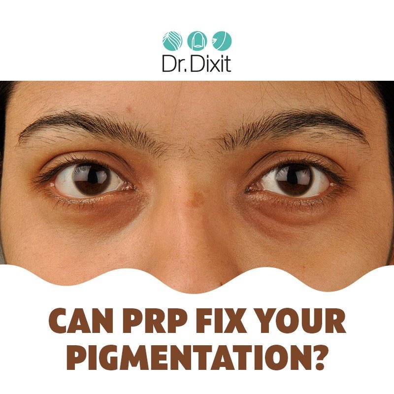 Pigmentation Treatment in Bangalore