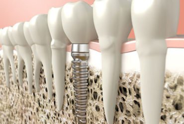 Best Dental Implant Clinic in Gurgaon