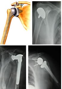 Shoulder Dislocation Treatment in Hyderabad | Visakapatnam