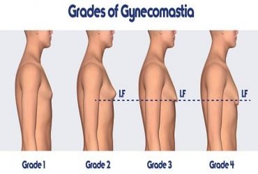 Gynecomastia surgeon in Jaipur