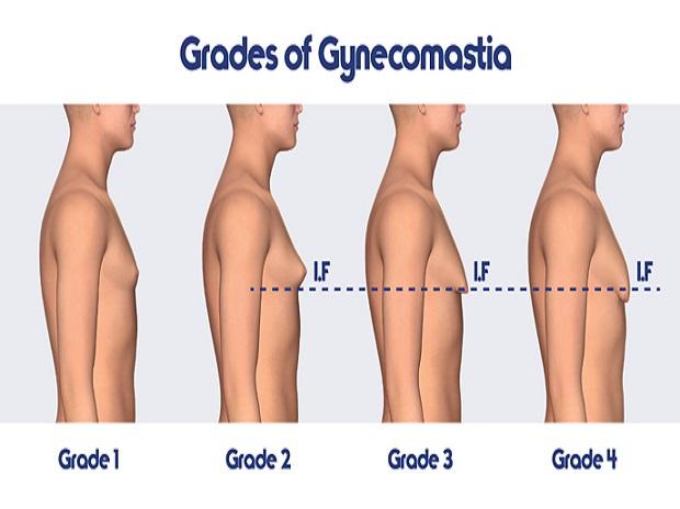 Gynecomastia surgeon in Jaipur