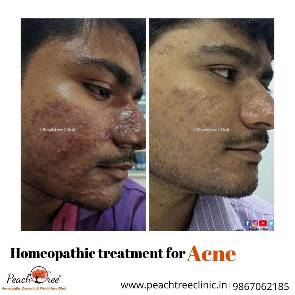 Acne treatment with homeopathy