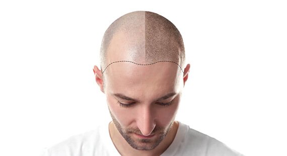 What is a FUE hair transplant?