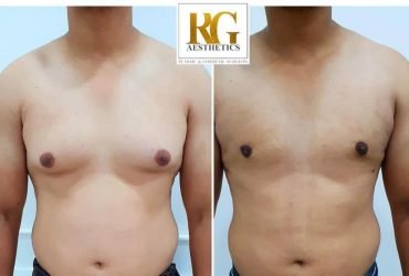 Male Breast Reduction Surgery in Delhi