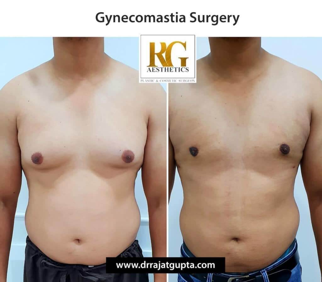 Male Breast Reduction Surgery in Delhi