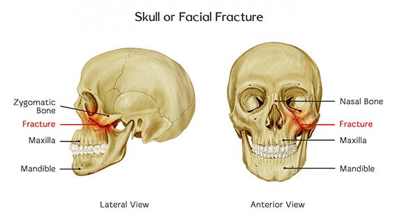 Facial Trauma management in Delhi