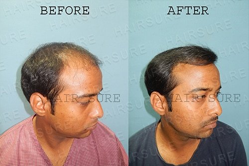 Best Hair Transplant clinic in Hyderabad |  Hitech City