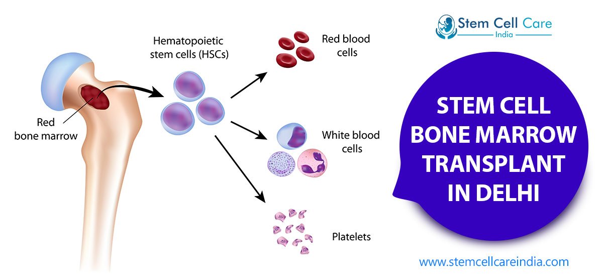 Private: Stem Cell Bone Marrow Transplant in Delhi